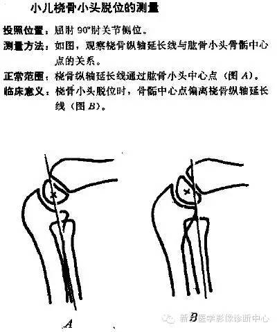 详细的肘关节X线解剖+摄影技巧+骨骺时间+测量方法 详细的肘关节X线解剖+摄影技巧+骨骺时间+测量方法