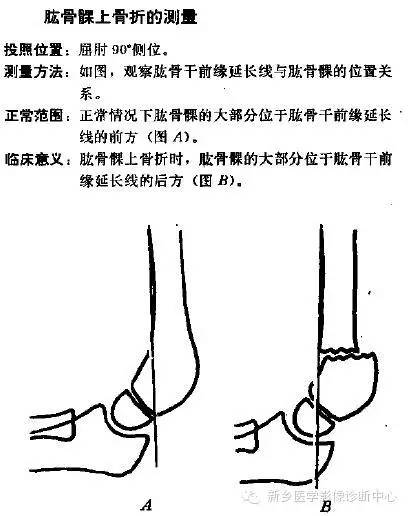 详细的肘关节X线解剖+摄影技巧+骨骺时间+测量方法 详细的肘关节X线解剖+摄影技巧+骨骺时间+测量方法