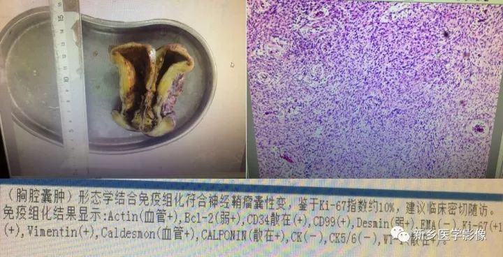 【病例】纵隔神经鞘瘤1例CT影像表现 【病例】纵隔神经鞘瘤1例CT影像表现