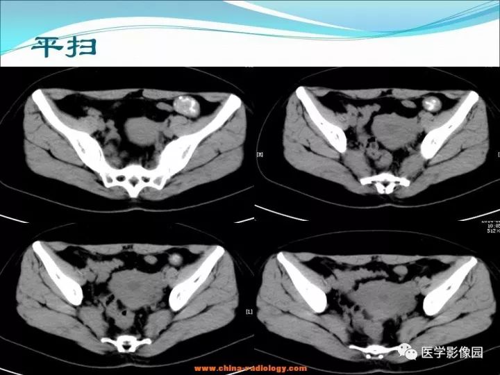 【病例】小肠平滑肌瘤1例CT影像表现