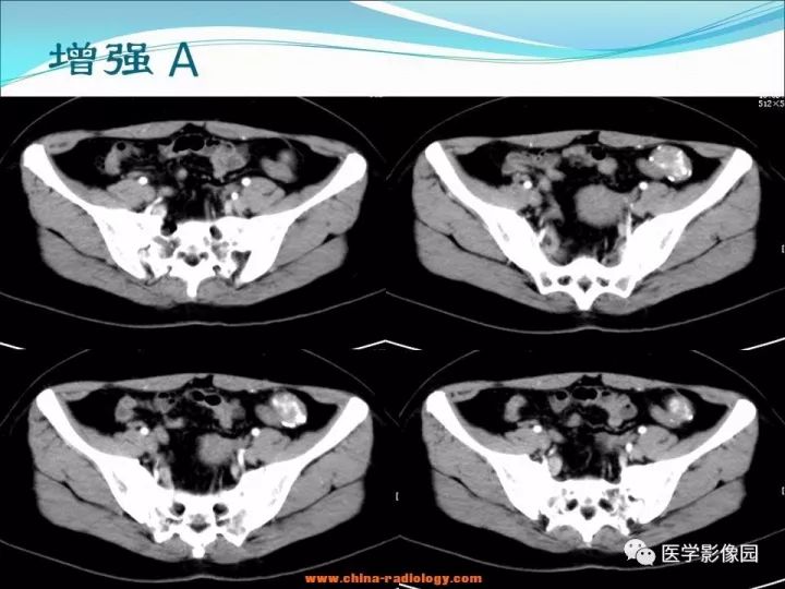 【病例】小肠平滑肌瘤1例CT影像表现