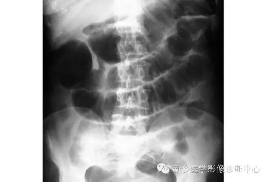 详细腹部平片解剖+正常表现+读片技巧+病例分析 详细腹部平片解剖+正常表现+读片技巧+病例分析