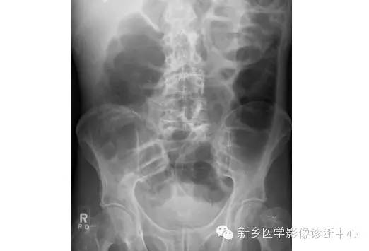 详细腹部平片解剖+正常表现+读片技巧+病例分析 详细腹部平片解剖+正常表现+读片技巧+病例分析
