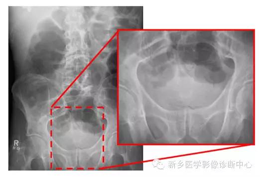 详细腹部平片解剖+正常表现+读片技巧+病例分析 详细腹部平片解剖+正常表现+读片技巧+病例分析