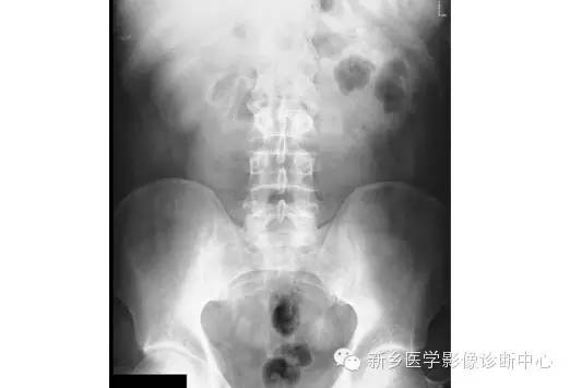 详细腹部平片解剖+正常表现+读片技巧+病例分析 详细腹部平片解剖+正常表现+读片技巧+病例分析