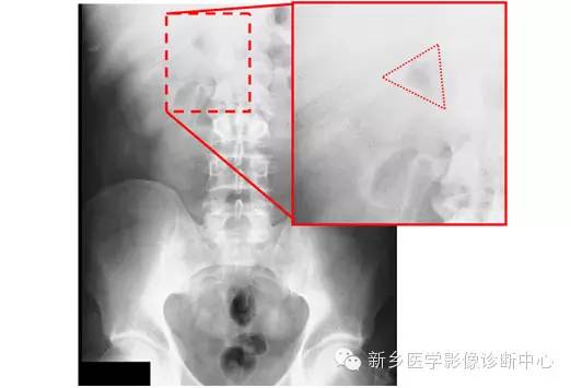 详细腹部平片解剖+正常表现+读片技巧+病例分析 详细腹部平片解剖+正常表现+读片技巧+病例分析