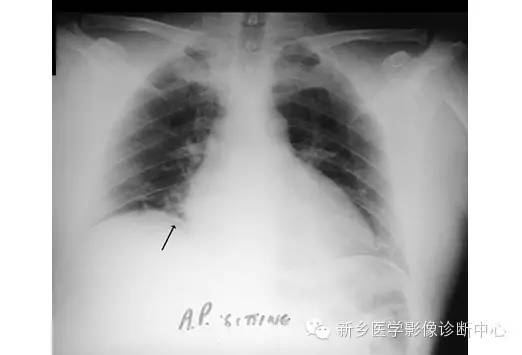 详细腹部平片解剖+正常表现+读片技巧+病例分析 详细腹部平片解剖+正常表现+读片技巧+病例分析