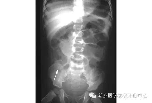 详细腹部平片解剖+正常表现+读片技巧+病例分析 详细腹部平片解剖+正常表现+读片技巧+病例分析