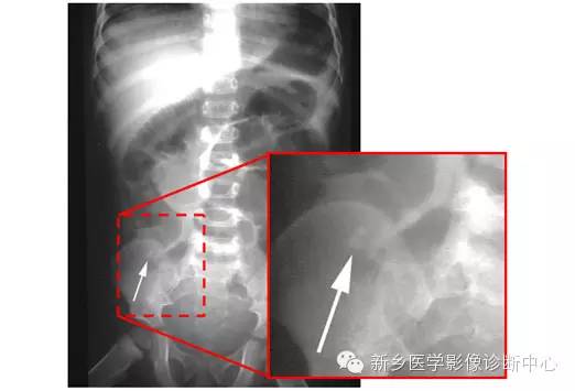 详细腹部平片解剖+正常表现+读片技巧+病例分析 详细腹部平片解剖+正常表现+读片技巧+病例分析