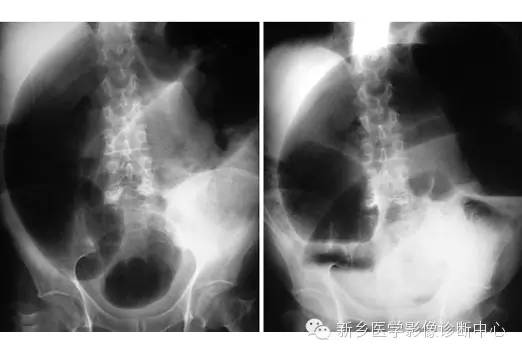 详细腹部平片解剖+正常表现+读片技巧+病例分析 详细腹部平片解剖+正常表现+读片技巧+病例分析