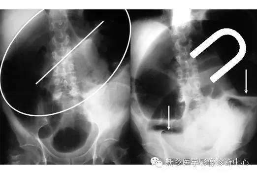 详细腹部平片解剖+正常表现+读片技巧+病例分析 详细腹部平片解剖+正常表现+读片技巧+病例分析