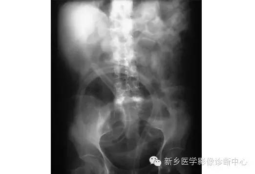 详细腹部平片解剖+正常表现+读片技巧+病例分析 详细腹部平片解剖+正常表现+读片技巧+病例分析