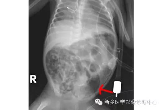 详细腹部平片解剖+正常表现+读片技巧+病例分析 详细腹部平片解剖+正常表现+读片技巧+病例分析