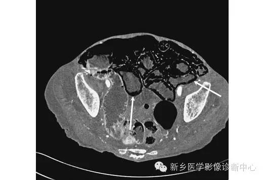 详细腹部平片解剖+正常表现+读片技巧+病例分析 详细腹部平片解剖+正常表现+读片技巧+病例分析