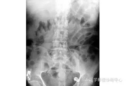 详细腹部平片解剖+正常表现+读片技巧+病例分析 详细腹部平片解剖+正常表现+读片技巧+病例分析