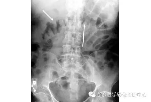 详细腹部平片解剖+正常表现+读片技巧+病例分析 详细腹部平片解剖+正常表现+读片技巧+病例分析