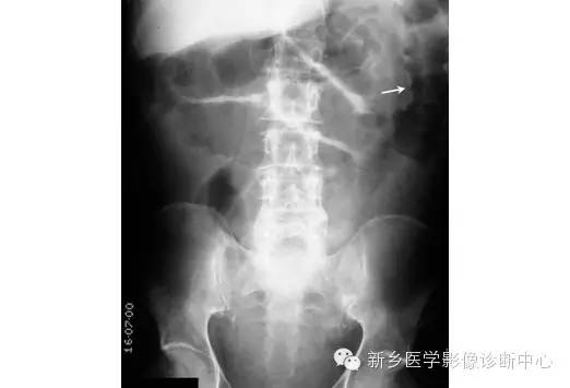 详细腹部平片解剖+正常表现+读片技巧+病例分析 详细腹部平片解剖+正常表现+读片技巧+病例分析