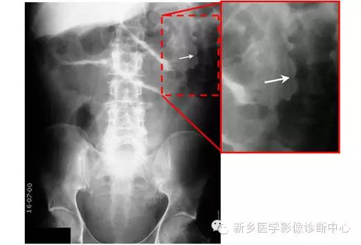 详细腹部平片解剖+正常表现+读片技巧+病例分析 详细腹部平片解剖+正常表现+读片技巧+病例分析
