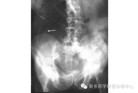 详细腹部平片解剖+正常表现+读片技巧+病例分析 详细腹部平片解剖+正常表现+读片技巧+病例分析