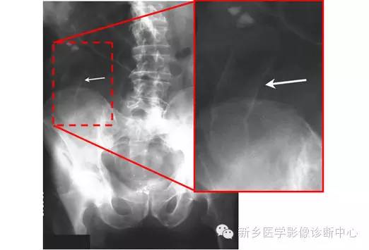 详细腹部平片解剖+正常表现+读片技巧+病例分析 详细腹部平片解剖+正常表现+读片技巧+病例分析