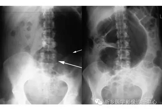 详细腹部平片解剖+正常表现+读片技巧+病例分析 详细腹部平片解剖+正常表现+读片技巧+病例分析