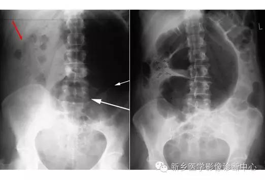 详细腹部平片解剖+正常表现+读片技巧+病例分析 详细腹部平片解剖+正常表现+读片技巧+病例分析