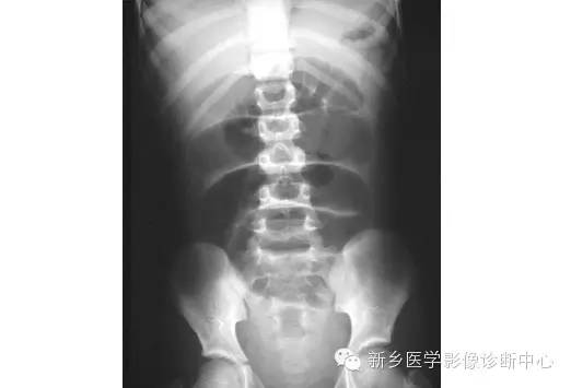 详细腹部平片解剖+正常表现+读片技巧+病例分析 详细腹部平片解剖+正常表现+读片技巧+病例分析
