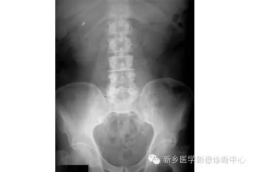详细腹部平片解剖+正常表现+读片技巧+病例分析 详细腹部平片解剖+正常表现+读片技巧+病例分析