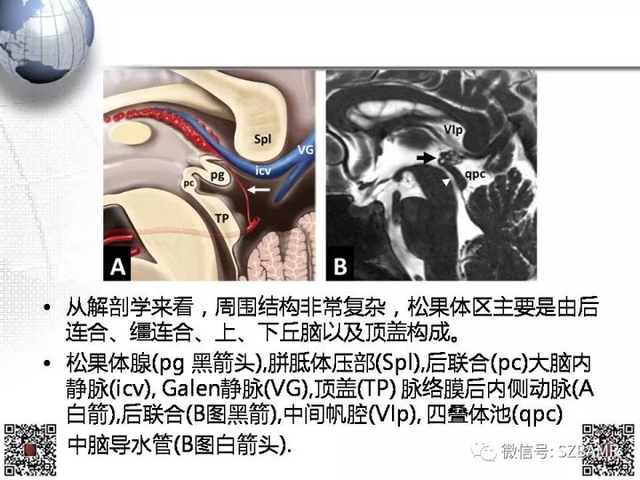 【PPT】松果体区占位—影像表现与手术路径