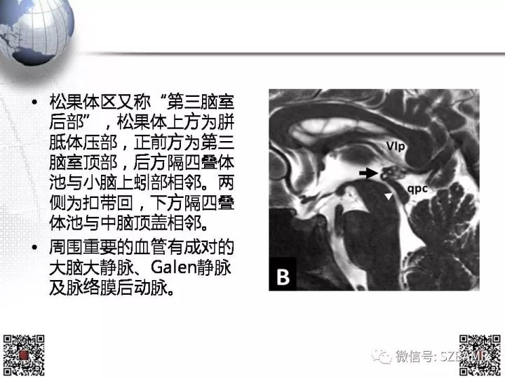 【PPT】松果体区占位—影像表现与手术路径