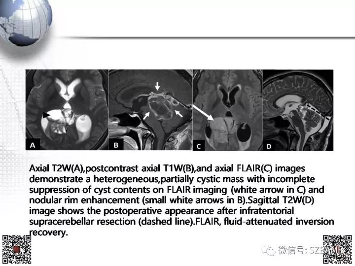 【PPT】松果体区占位—影像表现与手术路径