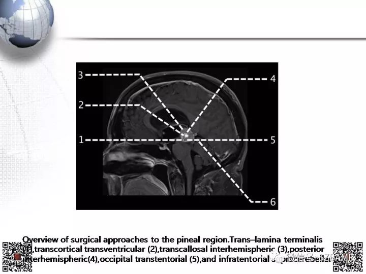 【PPT】松果体区占位—影像表现与手术路径