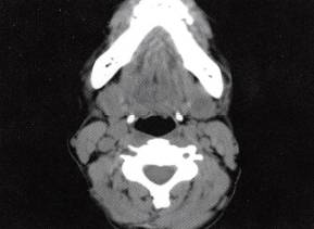 【病例】颌下腺腺样囊性癌1例CT影像表现 【病例】颌下腺腺样囊性癌1例CT影像表现