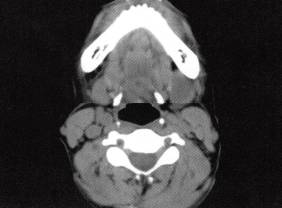 【病例】颌下腺腺样囊性癌1例CT影像表现 【病例】颌下腺腺样囊性癌1例CT影像表现