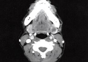 【病例】颌下腺腺样囊性癌1例CT影像表现 【病例】颌下腺腺样囊性癌1例CT影像表现