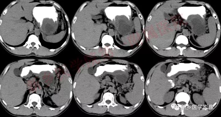 【病例】胰腺假性囊肿1例CT影像表现 【病例】胰腺假性囊肿1例CT影像表现