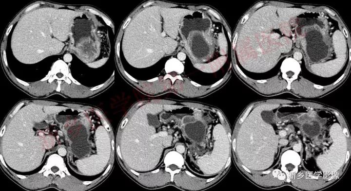 【病例】胰腺假性囊肿1例CT影像表现 【病例】胰腺假性囊肿1例CT影像表现