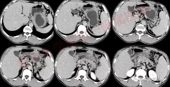 【病例】胰腺假性囊肿1例CT影像表现 【病例】胰腺假性囊肿1例CT影像表现