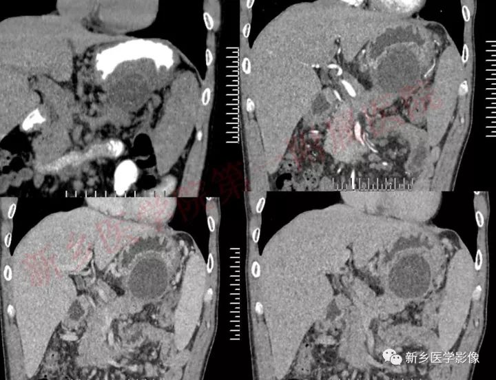 【病例】胰腺假性囊肿1例CT影像表现 【病例】胰腺假性囊肿1例CT影像表现