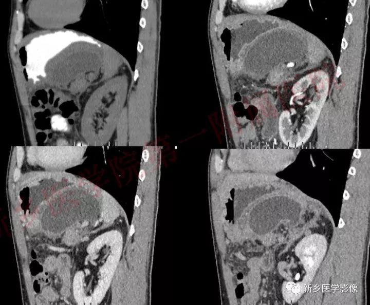 【病例】胰腺假性囊肿1例CT影像表现 【病例】胰腺假性囊肿1例CT影像表现