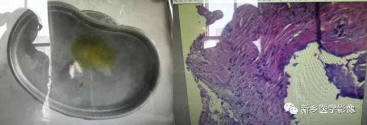 【病例】胰腺假性囊肿1例CT影像表现 【病例】胰腺假性囊肿1例CT影像表现