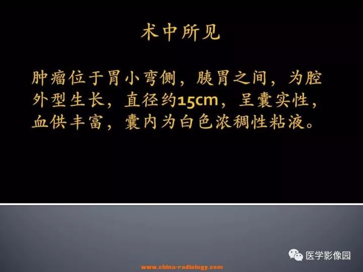【病例】胃间质瘤1例CT影像表现