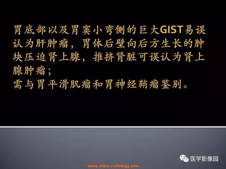 【病例】胃间质瘤1例CT影像表现