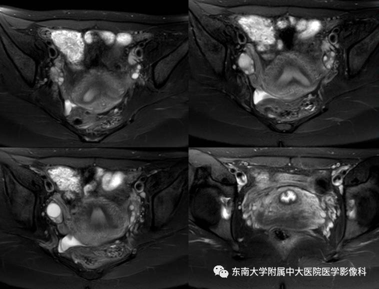 【病例】子宫发育畸形(纵隔子宫)1例MR