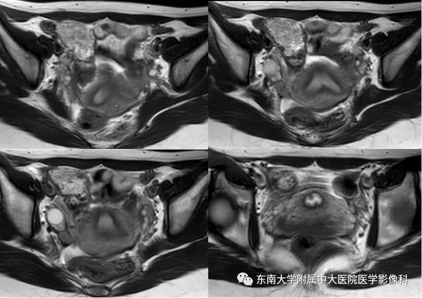 【病例】子宫发育畸形(纵隔子宫)1例MR
