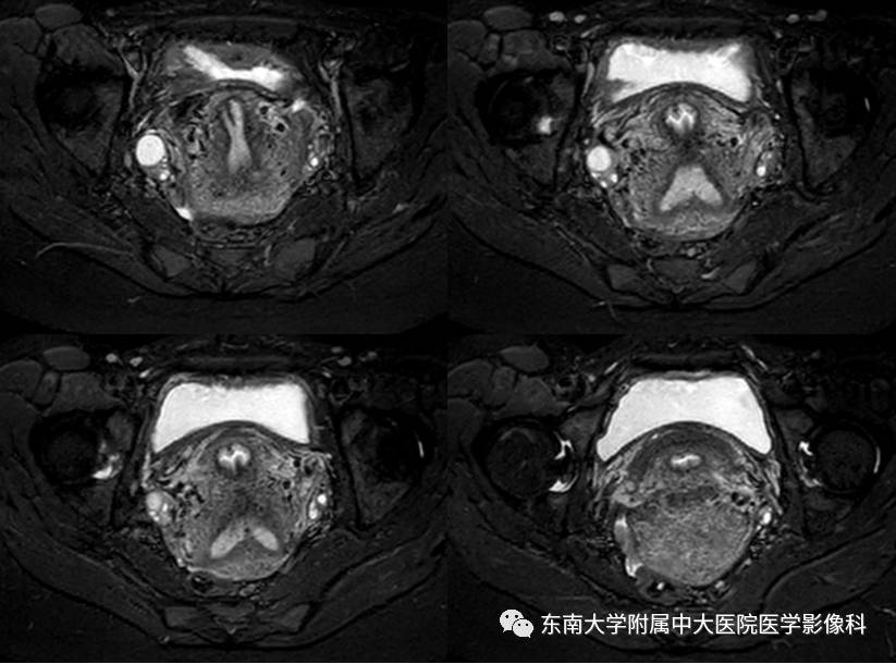 【病例】子宫发育畸形(纵隔子宫)1例MR