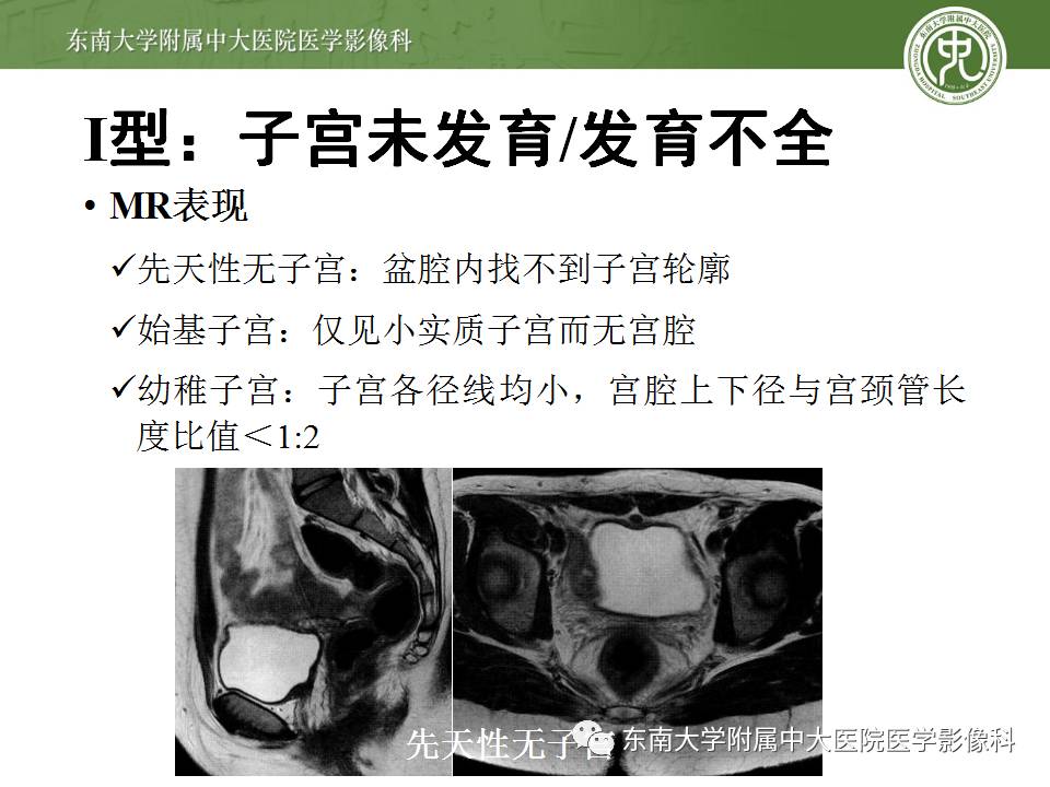 【病例】子宫发育畸形(纵隔子宫)1例MR