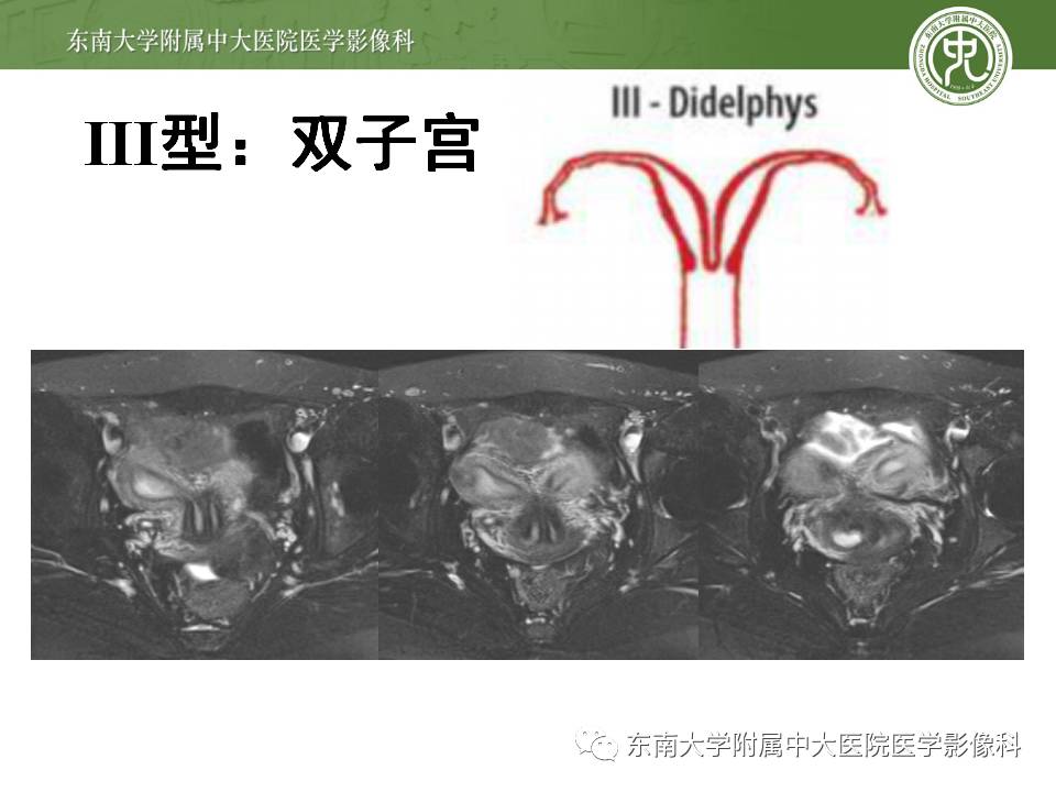 【病例】子宫发育畸形(纵隔子宫)1例MR