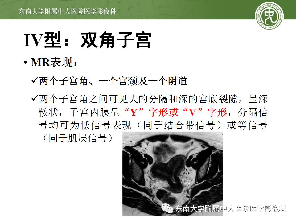 【病例】子宫发育畸形(纵隔子宫)1例MR