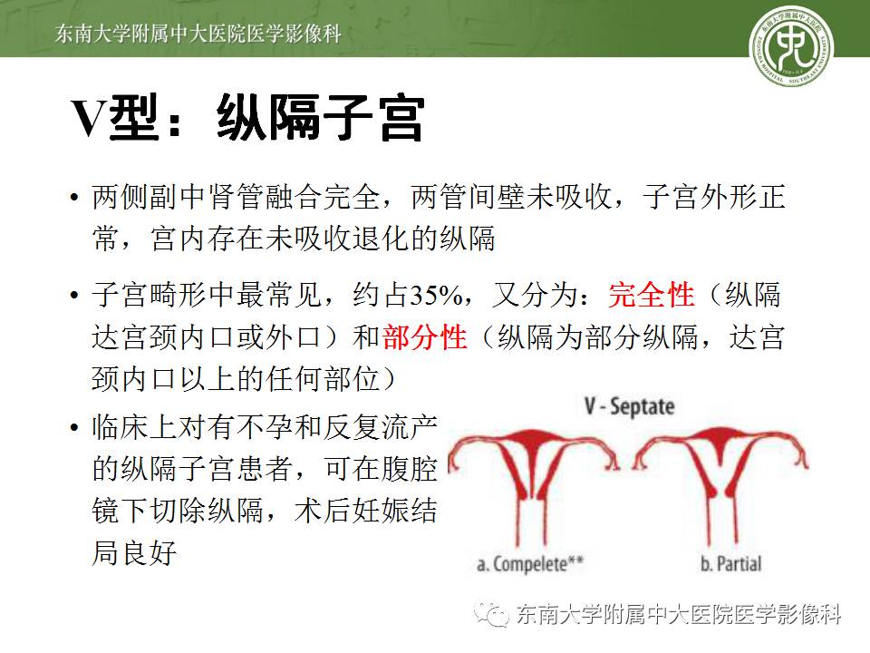 【病例】子宫发育畸形(纵隔子宫)1例MR